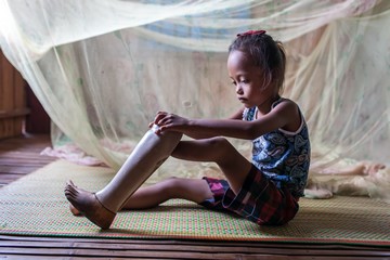 Channa (7 ans) est amputée congénitale. Sur cette photo, elle met sa prothèse avant d'aller à l'école