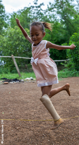 Channa Cambodge Prothèse 